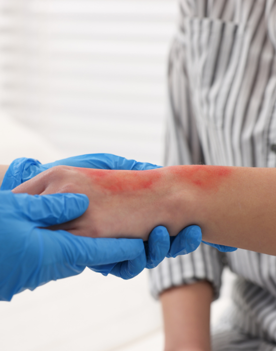 Burn injury liability determination