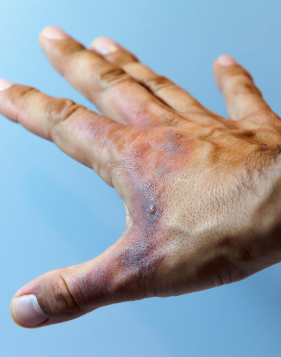Types And Degrees Of Burns