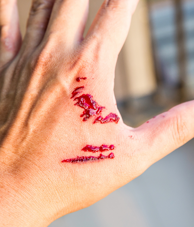 What Compensation May Be Available for Dog Bite Injuries